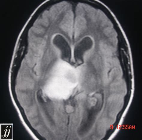 astrocytoma – Radiopaedia