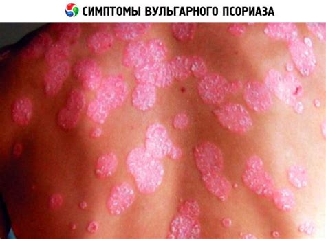 Vulgar psoriasis: causes, symptoms, diagnosis, treatment