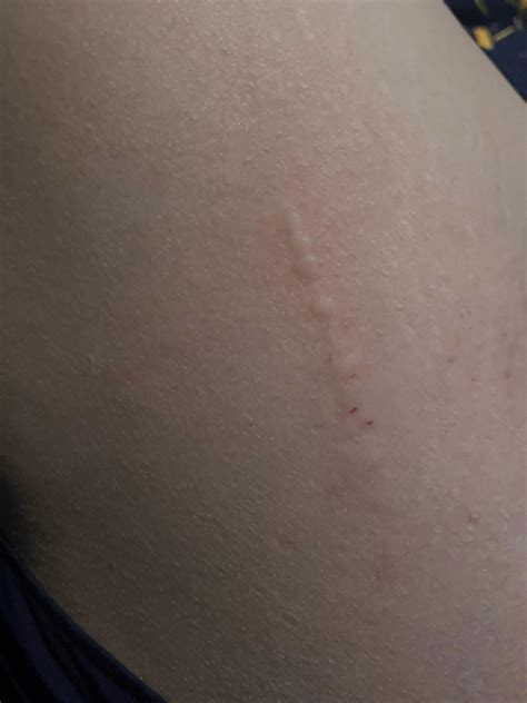 Linear itchy rash… what is this from? : r/DermatologyQuestions