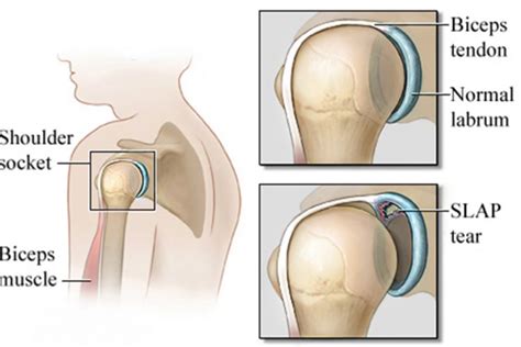 Best Arthroscopic SLAP Repair Hospital in Bangalore | Slap & Labrum Tear