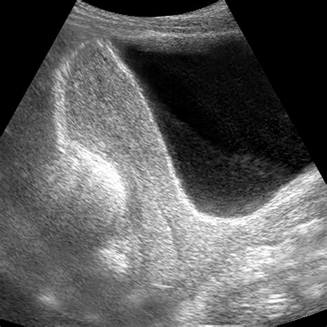 Anteverted uterus, ultrasound [4 of 4]