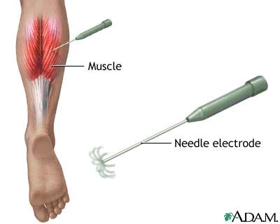 Electromyography: MedlinePlus Medical Encyclopedia Image