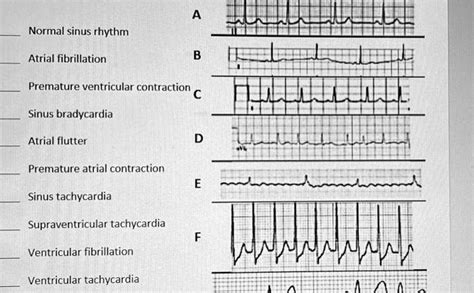 SOLVED: Normal sinus rhythm Atrial fibrillation B Sinus bradycardia Atrial flutter D Premature ...