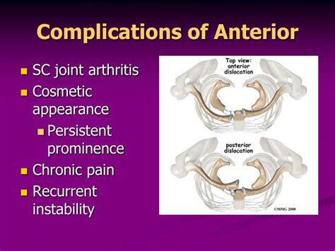 PPT - Sternoclavicular joint dislocation PowerPoint Presentation - ID ...