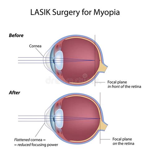 Lasik Eye Surgery For Myopia Stock Vector - Image: 23100505