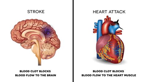 Avoid A Heart Attack or Stroke: 10 Foods to Never Ignore