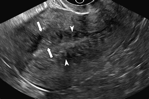 Adenomyosis: A Sonographic Diagnosis | RadioGraphics