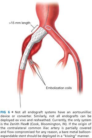 Advanced Aneurysm Management Techniques: Management of Internal Iliac Aneurysm Disease ...