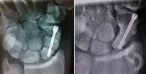 Scaphoid non-union treated with the bone graft inserted between two non ...