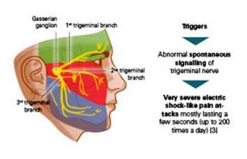 Trigeminal Neuralgia Treatment, Symptoms, What is, Surgery, Causes