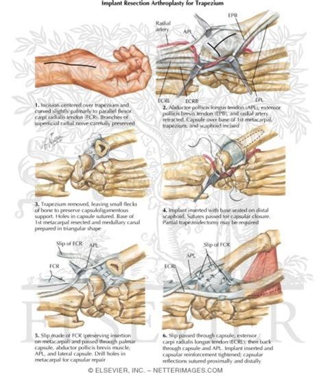 Trapezium Implant Resection Arthroplasty for Thumb Disabilities