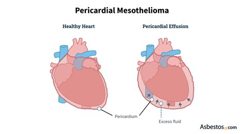 Pericardial Effusion: Symptoms, Causes And Treatment, 42% OFF