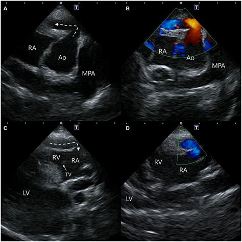 Frontiers | Case report: Imaging features of aorta-right atrial tunnel ...