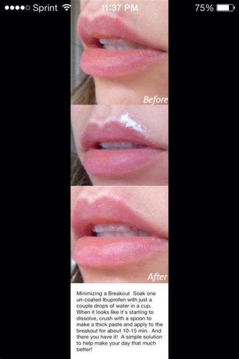 How To Get Rid Of Blackheads On Upper Lip Line | Ownerlip.co