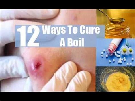 How To Cure A Boil - YouTube