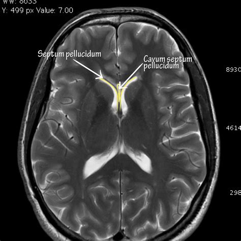 Neuroanatomy Glossary: Cavum Septum Pellucidum | ditki medical ...