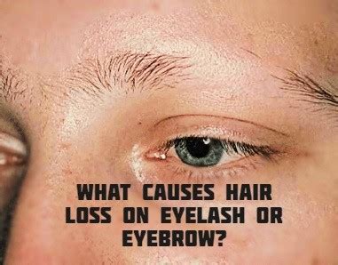 What causes hair loss on eyelash or eyebrow? - HealthZigZag