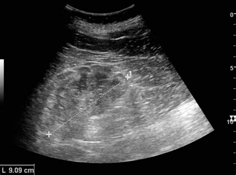 Kidney Ultrasound Clinic - CRCTC Public - CRCTC