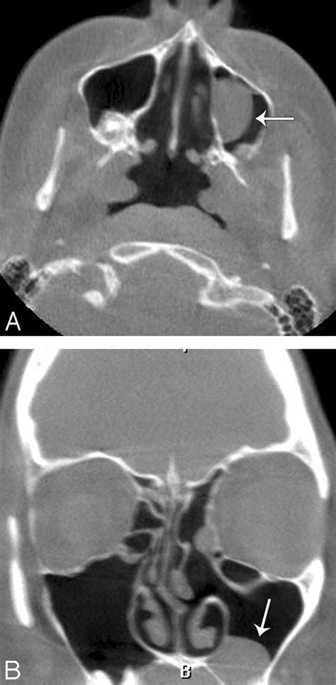 Ruptured Maxillary Retention Cyst: Cause of Unilateral Rhinorrhea after ...