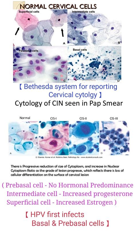 Cervical cytology - Normal & Abnormal 【 Note : Increase Nucleus ...