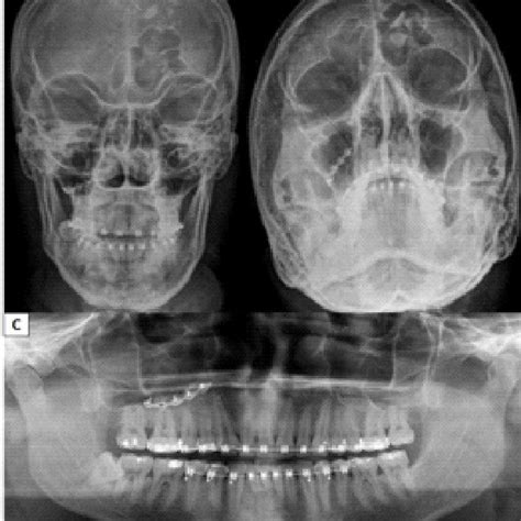 Fracture of the anterior wall of the right maxillary sinus (A);... | Download Scientific Diagram