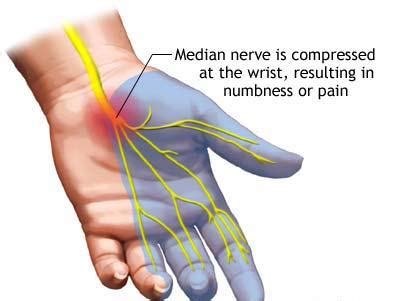 EMG Best Test To Diagnose Carpal Tunnel | Neuro Testing Group - Expert EMG/NCV Nerve Testing