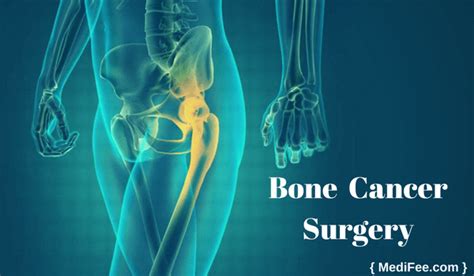 Bone Cancer Treatment: Surgery Procedures, Stages, Risks and Recovery