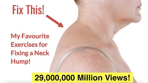 How to Fix a Neck Hump at Home (FAST) | With FREE Exercise Sheet! – FastestWellness