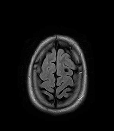 Neuroglial cyst | Image | Radiopaedia.org