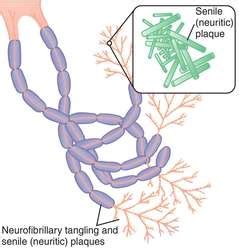 Neurofibrillary tangles | definition of neurofibrillary tangles by ...