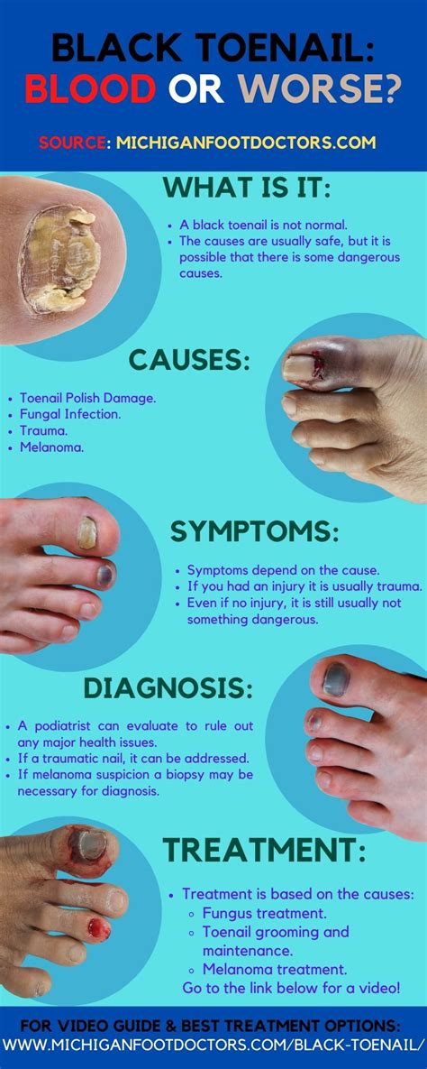 Black Toenail Treatment: [Causes, Symptoms & Remedy!]