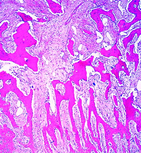 Pathology Outlines - Myositis ossificans