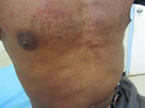 Erin in PNG: Measles Outbreak continued