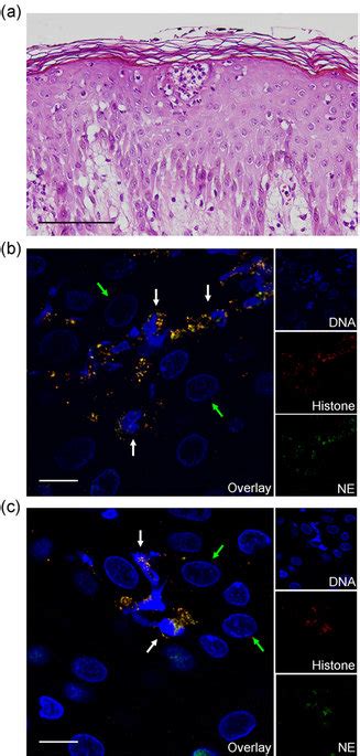 Neutrophils undergoing NETosis are frequently observed in the epidermis... | Download Scientific ...