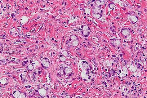 Goblet cell adenocarcinoma - Libre Pathology