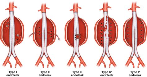 Types of endoleaks. | The originals, Static