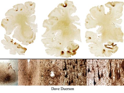 Northwestern Neurologist Calls New CTE Study "Jaw Dropping" - CBS Chicago