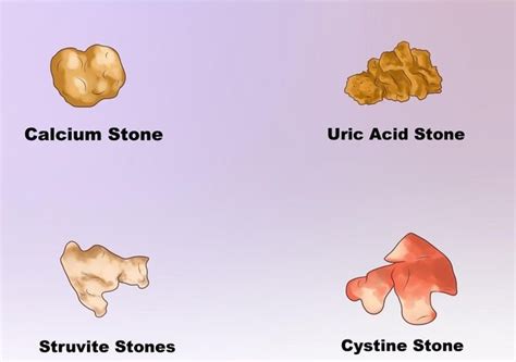 Cystine Kidney Stones