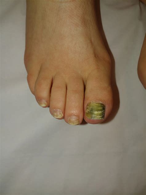 Green Nail Pseudomonas Infection | Fungal Laser Nail Surgery Specialist Clinic in London