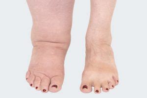 Causes and Treatment of Foot and Ankle Oedema and Lymphoedema - Compleet Feet