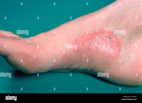 PSORIASIS ON FOOT Stock Photo - Alamy