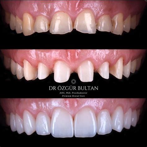 🇬🇧Intraoral photos of my previous post… Dull zirconia veneers were ...