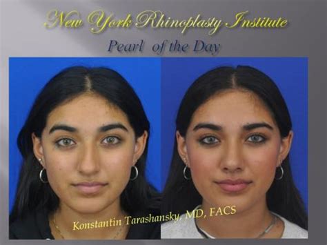 Patient Gallery | New York Rhinoplasty