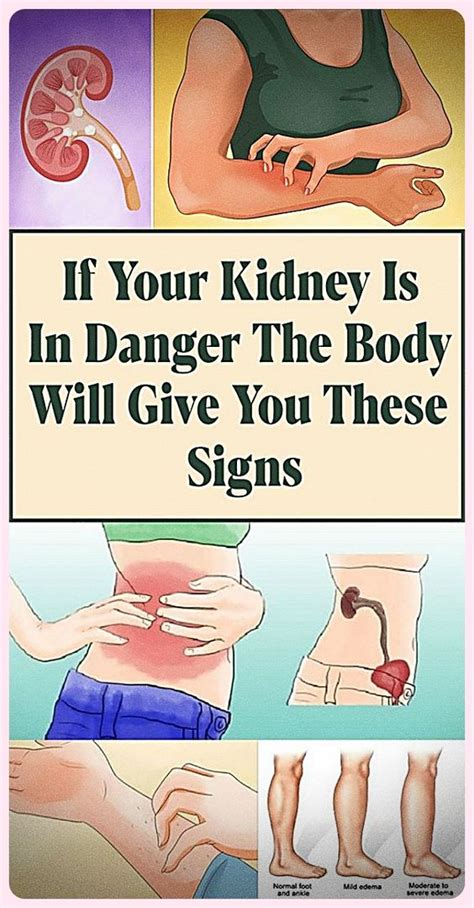 If Your Kidney Is in Danger, the Body Will Give You These 7 Signs ...