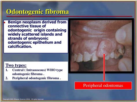 Odontogenic tumor