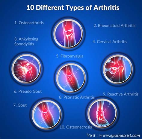 Juvenile Arthritis Treatment With Early Diagnosis | Different types of arthritis, Types of ...