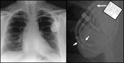 mri safety Archives - Precise Imaging