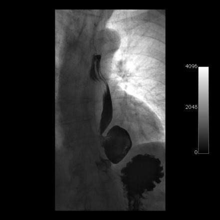 Epiphrenic diverticulum | Radiology Reference Article | Radiopaedia.org