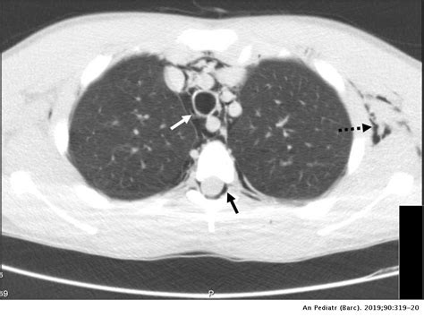 Pneumorrhachis: A finding in spontaneous pneumomediastinum | Anales de Pediatría (English Edition)