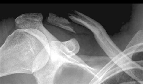 Distal Clavicle Fracture